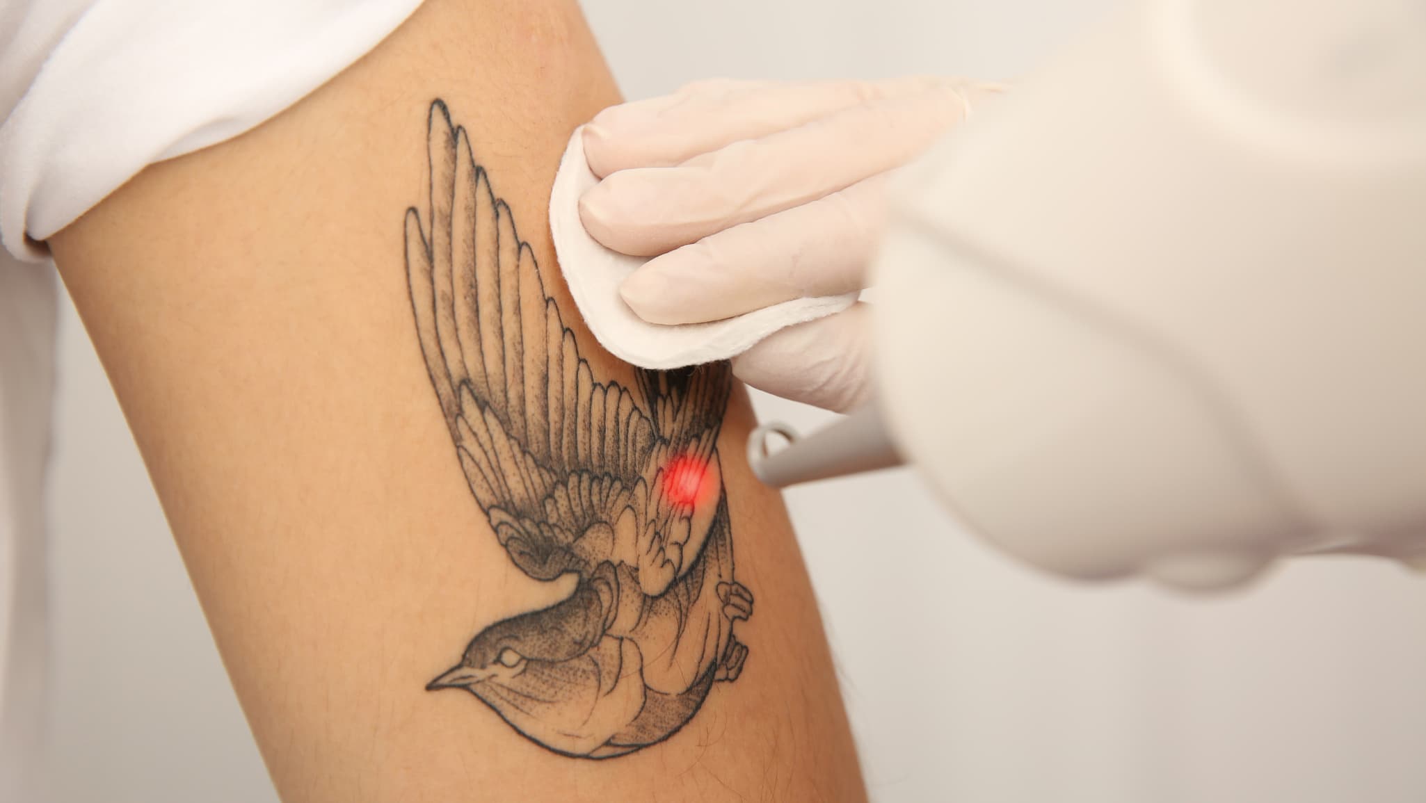 A laser handpiece treating a small black bird tattoo on an upper arm