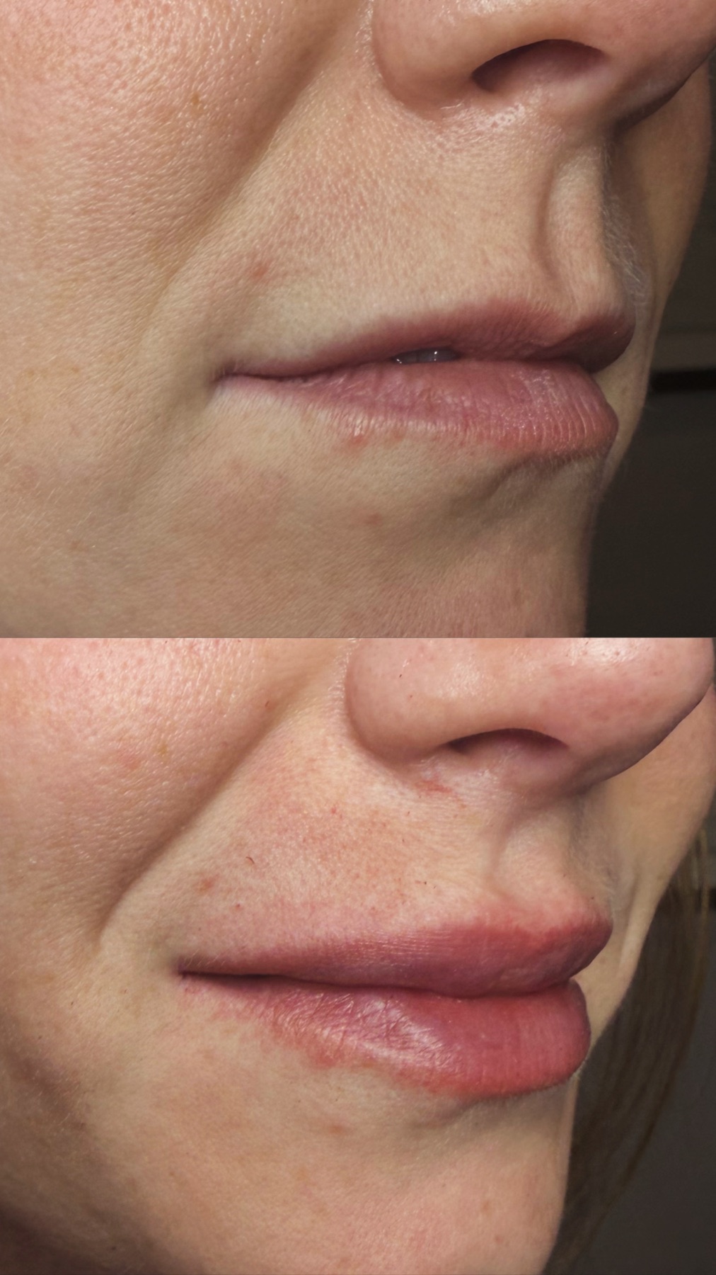 Before and after a lip booster treatment by Hunny, showing fuller and better defined lips